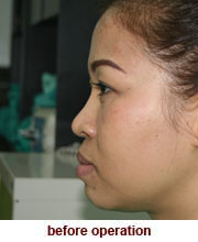 plastic_surgery_augmentation_rhinoplasty